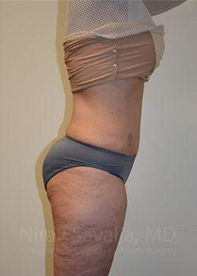 Breast Lift with Implants Before & After Gallery - Patient 1655672 - After