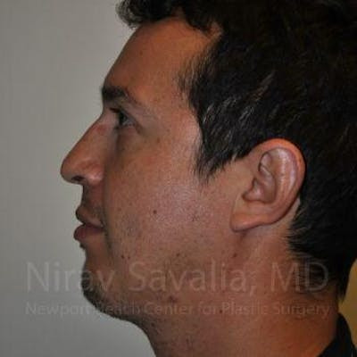 Chin Implants Before & After Gallery - Patient 1655678