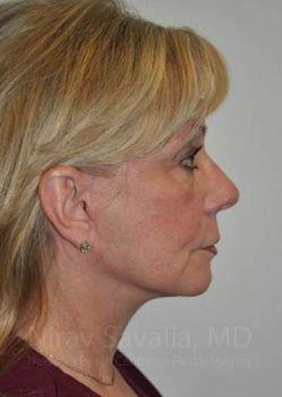 Chin Implants Before & After Gallery - Patient 1655682 - After
