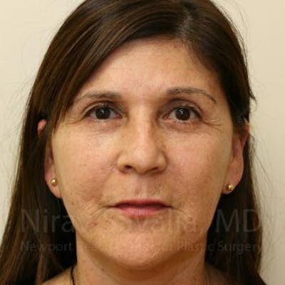 Brow Lift Before & After Gallery - Patient 1655702