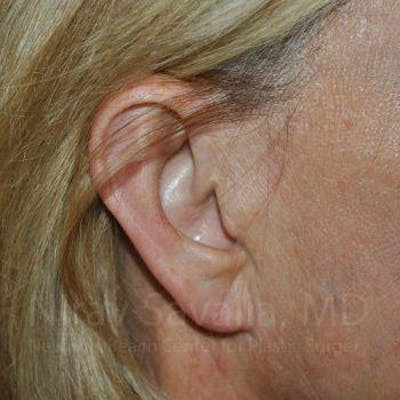 Oncoplastic Reconstruction Before & After Gallery - Patient 1655697 - After