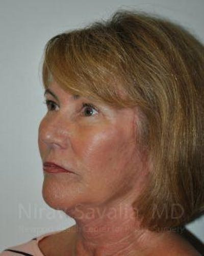 Brow Lift Before & After Gallery - Patient 1655698 - After