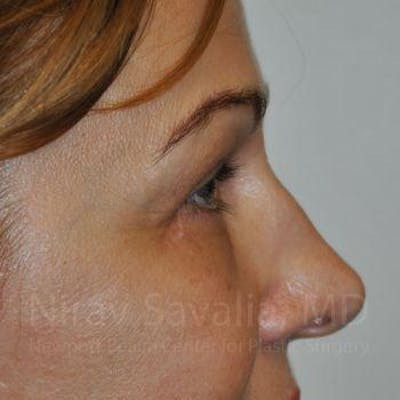 Brow Lift Before & After Gallery - Patient 1655701 - After