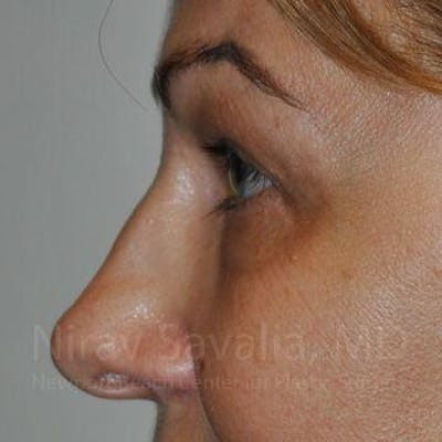 Chin Implants Before & After Gallery - Patient 1655701 - After