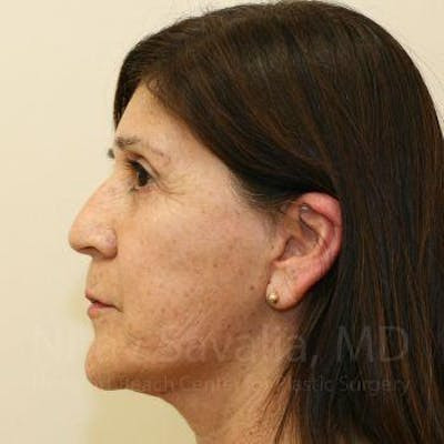 Chin Implants Before & After Gallery - Patient 1655702 - After
