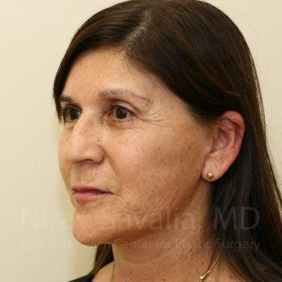 Chin Implants Before & After Gallery - Patient 1655702 - After