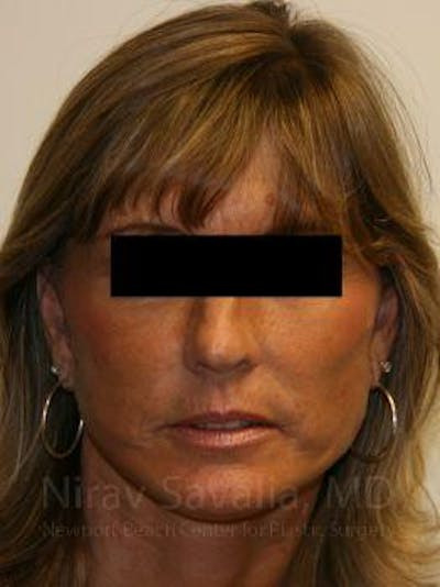 Facelift Before & After Gallery - Patient 1655704 - After