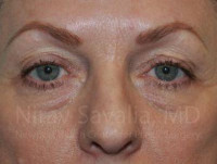Eyelid Surgery Before & After Gallery - Patient 1655707 - Image 1