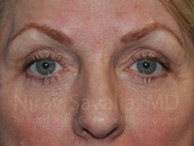 Brow Lift Before & After Gallery - Patient 1655707