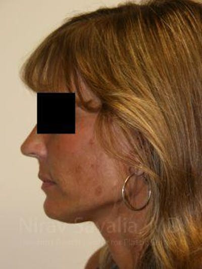Chin Implants Before & After Gallery - Patient 1655704 - After