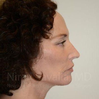Brow Lift Before & After Gallery - Patient 1655712