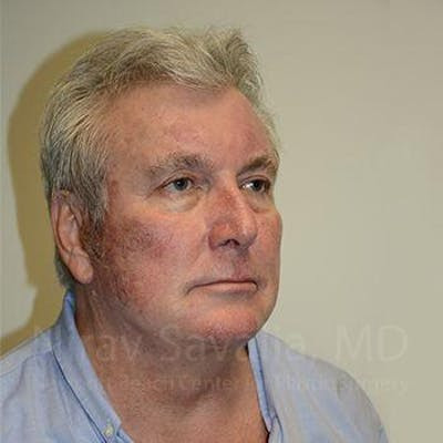 Chin Implants Before & After Gallery - Patient 1655717 - After