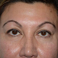 Eyelid Surgery Before & After Gallery - Patient 1655728 - Image 1