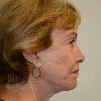 Brow Lift Before & After Gallery - Patient 1655786