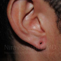 Torn Earlobe Repair Ear Gauge Repair Before & After Gallery - Patient 1655790 - Image 1
