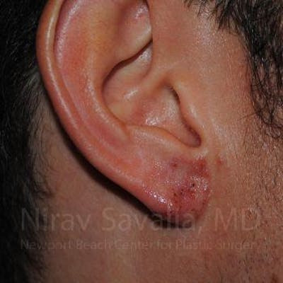 Torn Earlobe Repair Ear Gauge Repair Before & After Gallery - Patient 1655790 - After