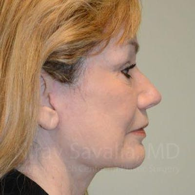 Chin Implants Before & After Gallery - Patient 1655795 - After