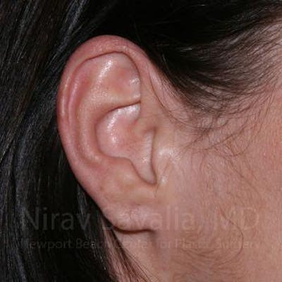 Torn Earlobe Repair Ear Gauge Repair Before & After Gallery - Patient 1655797 - After