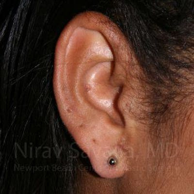 Torn Earlobe Repair Ear Gauge Repair Before & After Gallery - Patient 1655800 - After