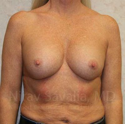 Chin Implants Before & After Gallery - Patient 1655444 - Before