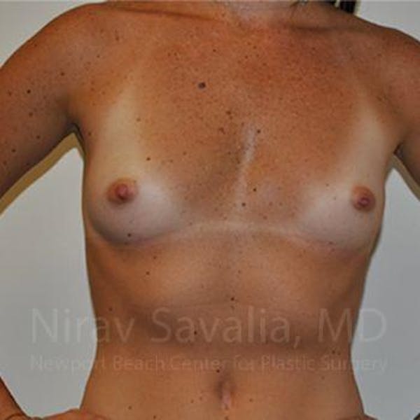 Breast Reduction Before & After Gallery - Patient 1655445 - Before