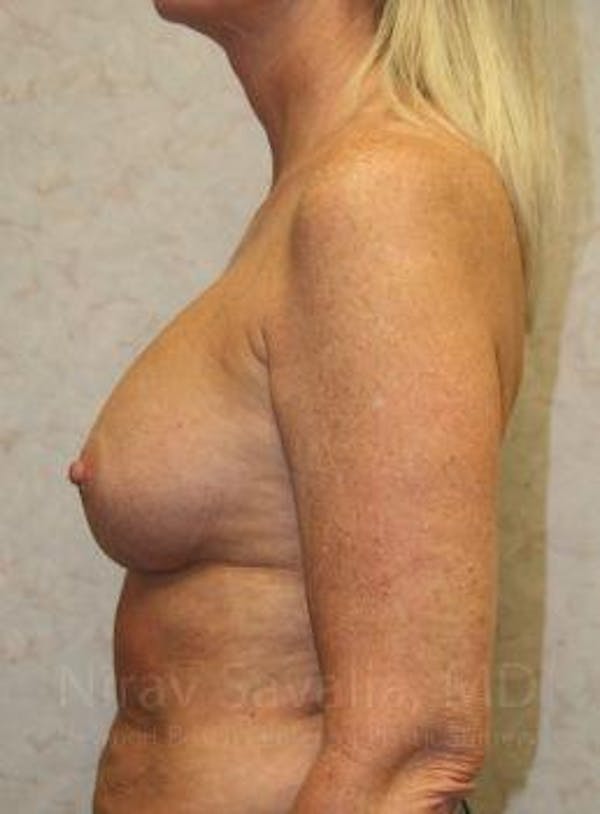 Mastectomy Reconstruction Before & After Gallery - Patient 1655444 - Before