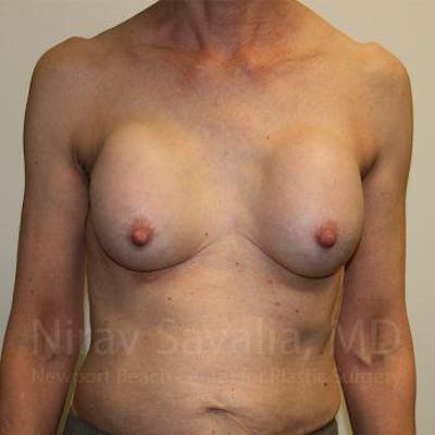 Chin Implants Before & After Gallery - Patient 1655447 - Before