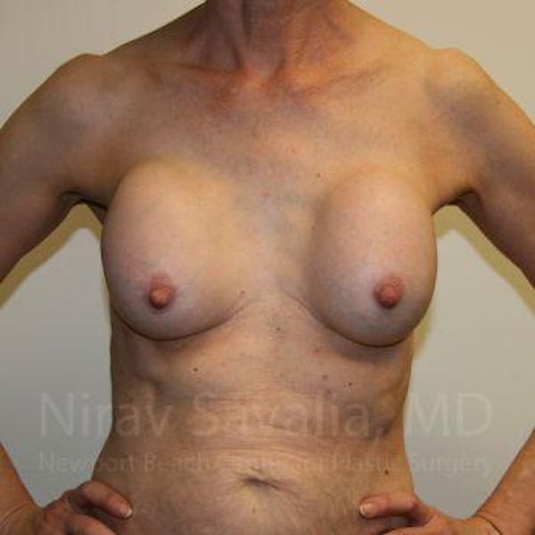Breast Lift with Implants Before & After Gallery - Patient 1655447 - Before