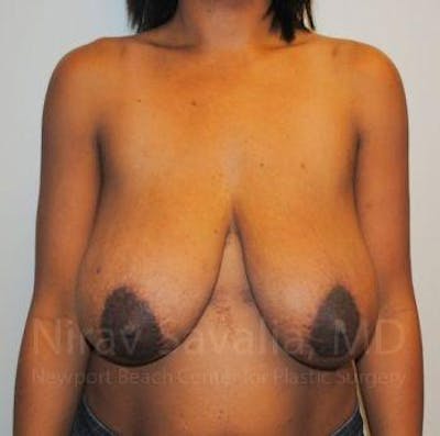 Breast Lift with Implants Before & After Gallery - Patient 1655451 - Before