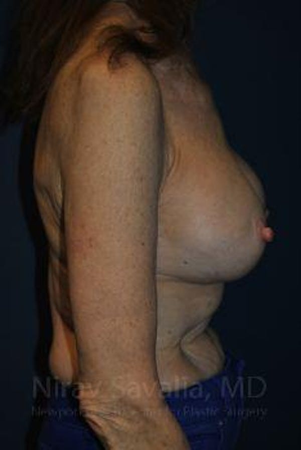 Oncoplastic Reconstruction Before & After Gallery - Patient 1655452 - Before