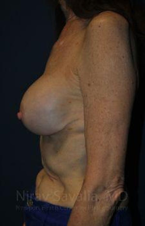 Oncoplastic Reconstruction Before & After Gallery - Patient 1655452 - Before