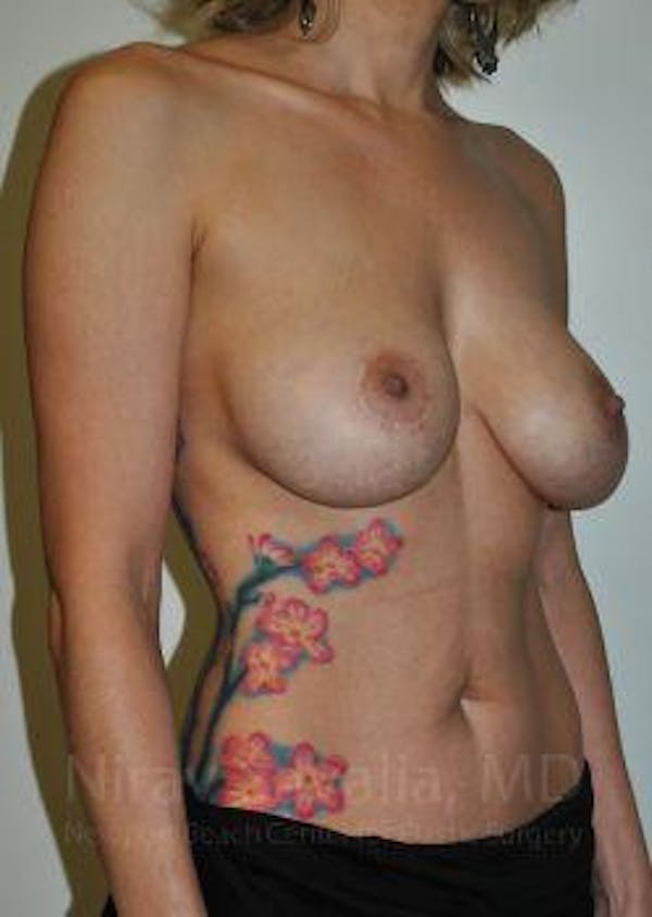 Breast Explantation En Bloc Capsulectomy Before & After Gallery - Patient 1655455 - Before