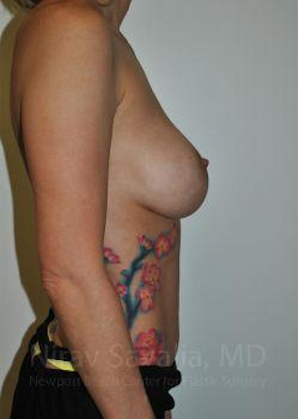 Breast Explantation En Bloc Capsulectomy Before & After Gallery - Patient 1655455 - Before