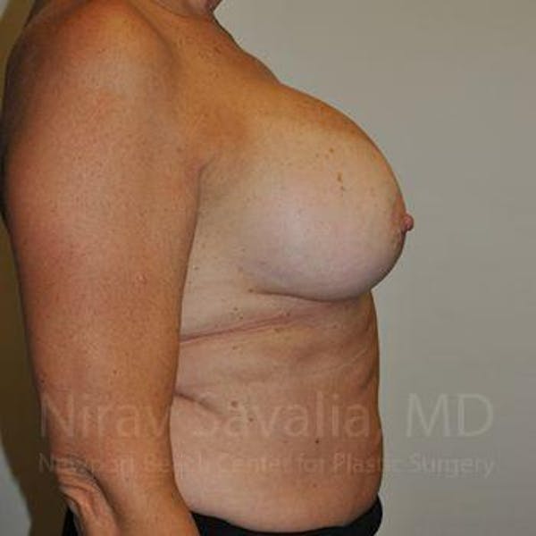 Liposuction Before & After Gallery - Patient 1655463 - Before