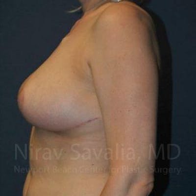 Breast Explantation En Bloc Capsulectomy Before & After Gallery - Patient 1655461 - After