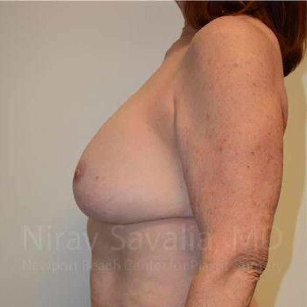 Breast Explantation En Bloc Capsulectomy Before & After Gallery - Patient 1655458 - Before
