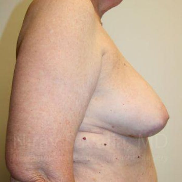 Breast Explantation En Bloc Capsulectomy Before & After Gallery - Patient 1655457 - Before