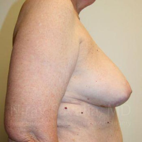 Body Contouring after Weight Loss Before & After Gallery - Patient 1655457 - Before