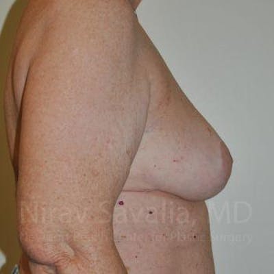 Breast Explantation En Bloc Capsulectomy Before & After Gallery - Patient 1655457 - After