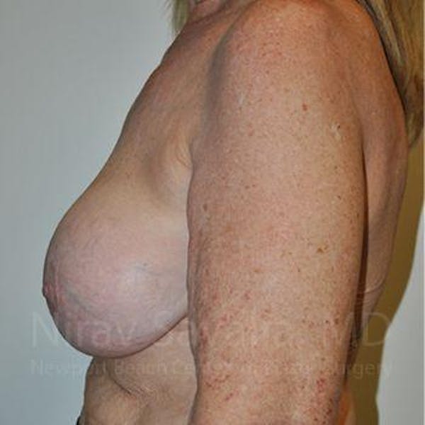 Breast Reduction Before & After Gallery - Patient 1655462 - Before