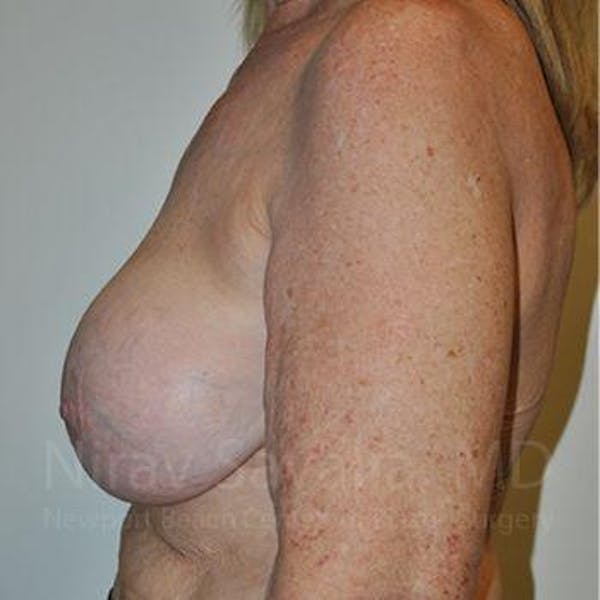 Breast Lift with Implants Before & After Gallery - Patient 1655462 - Before