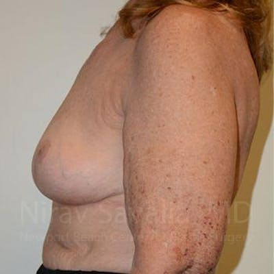 Oncoplastic Reconstruction Before & After Gallery - Patient 1655462 - After