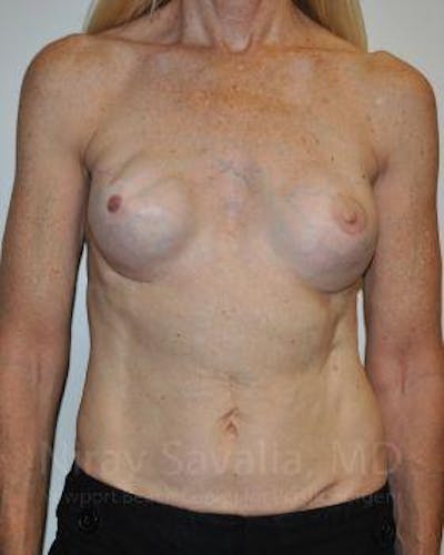 Chin Implants Before & After Gallery - Patient 1655466 - Before