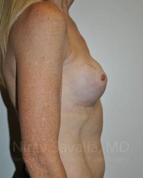 Breast Lift without Implants Before & After Gallery - Patient 1655466 - Before