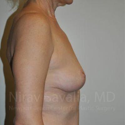 Liposuction Before & After Gallery - Patient 1655472 - After