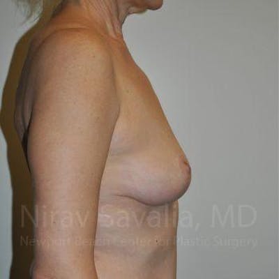 Chin Implants Before & After Gallery - Patient 1655472 - After