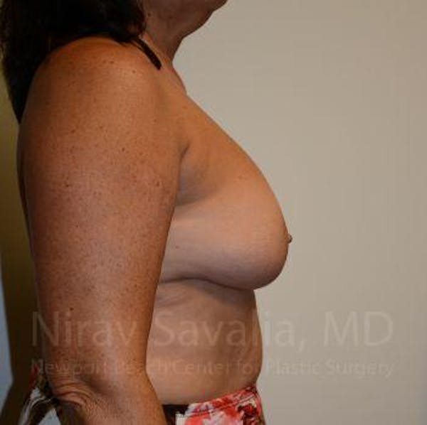 Thigh Lift Before & After Gallery - Patient 1655471 - Before