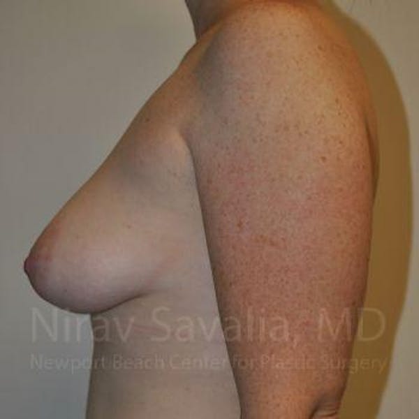 Breast Lift with Implants Before & After Gallery - Patient 1655468 - Before