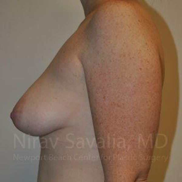 Oncoplastic Reconstruction Before & After Gallery - Patient 1655468 - Before