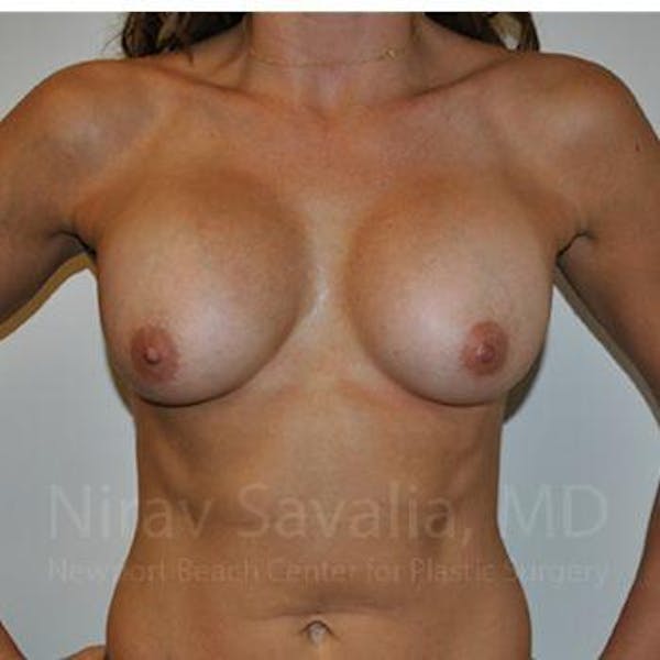 Breast Lift with Implants Before & After Gallery - Patient 1655470 - Before